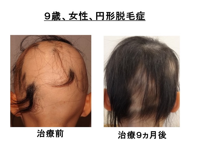 円形脱毛症　病院